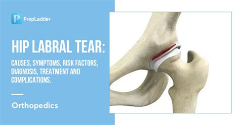 Diagnosing a Hip Labral Tear 